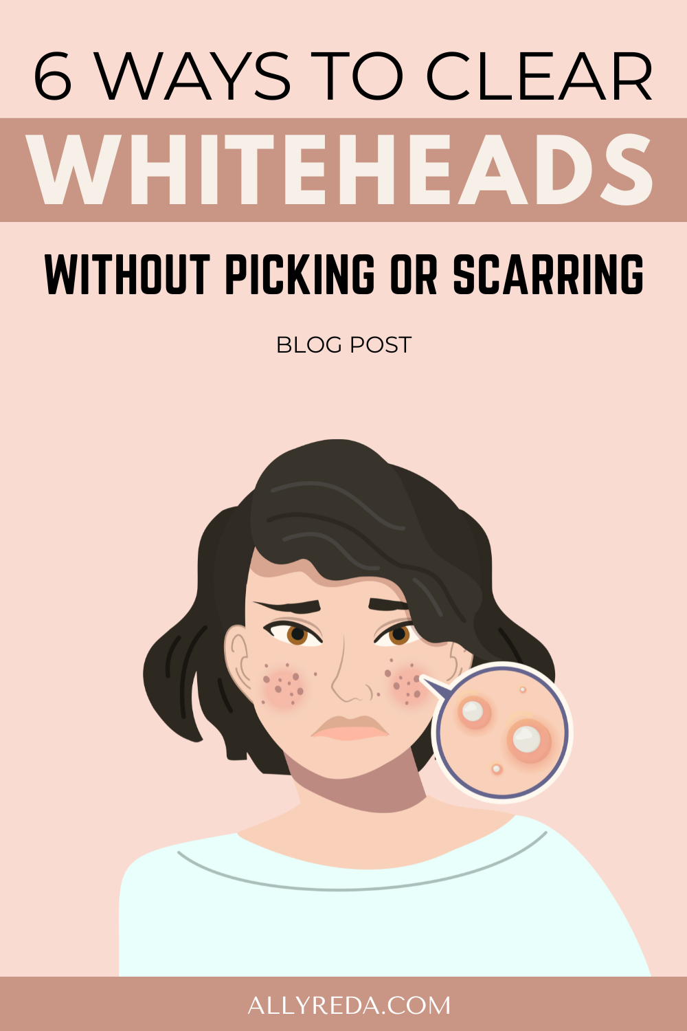 Clear Your Skin, Diy Whitehead Removal, Chin Whiteheads, Whiteheads Remedy, White Heads On Nose